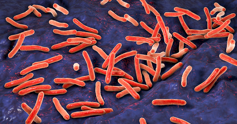 Tuberculosis